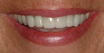 What are Dental Crowns?