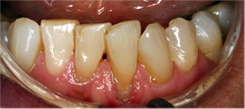 lower Gum Before Treatment gum before treatment